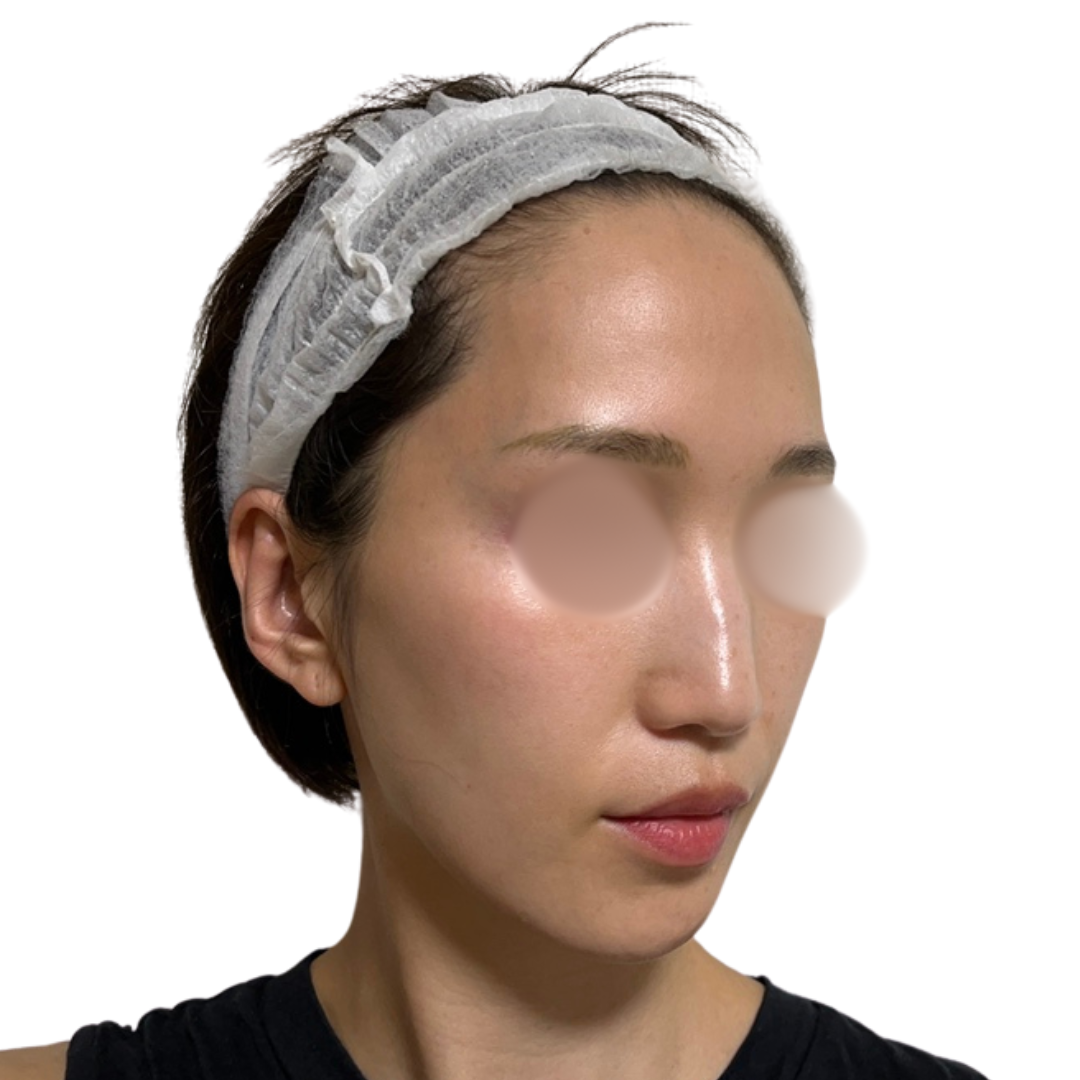 ピコフォーカス（ピコトーニング＋ピコフラクショナル）